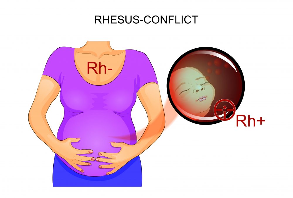 Incompatibilitatea Rh in sarcina